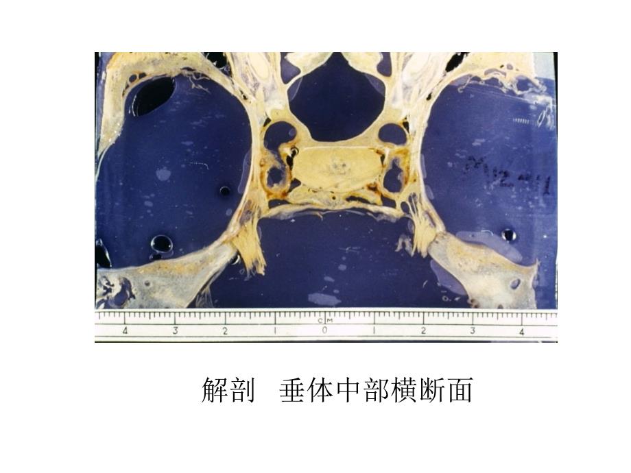 海绵窦病变影像学诊断课件_第4页