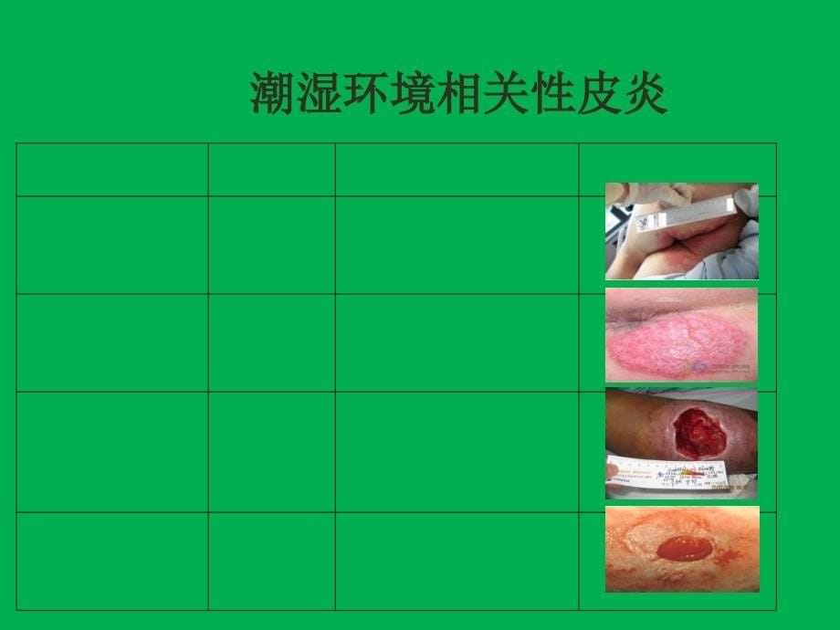 失禁性皮炎与压疮的鉴别与护理_第5页