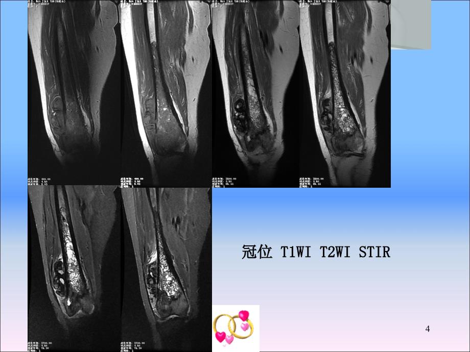 原发骨脂肪肉瘤课件_第4页