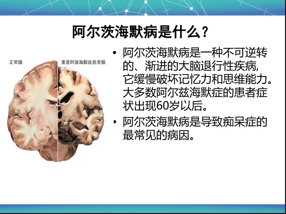 阿尔海默茨氏综合症(老年性痴呆).ppt_第2页