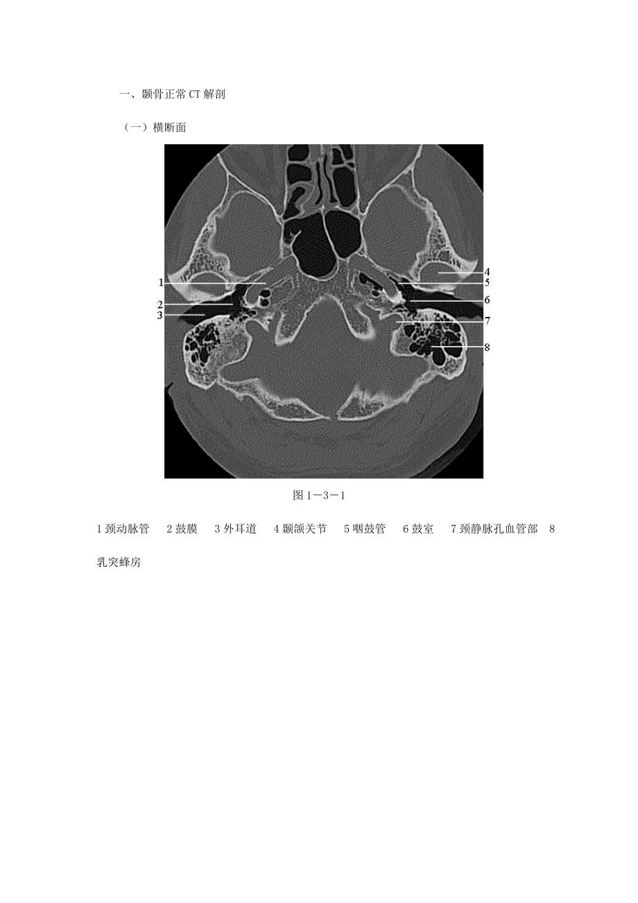 颞骨正常CT解剖(附图).doc_第1页