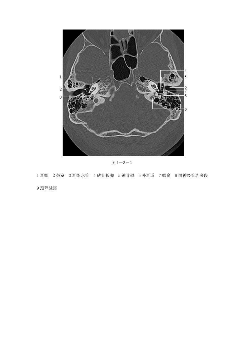 颞骨正常CT解剖(附图).doc_第2页