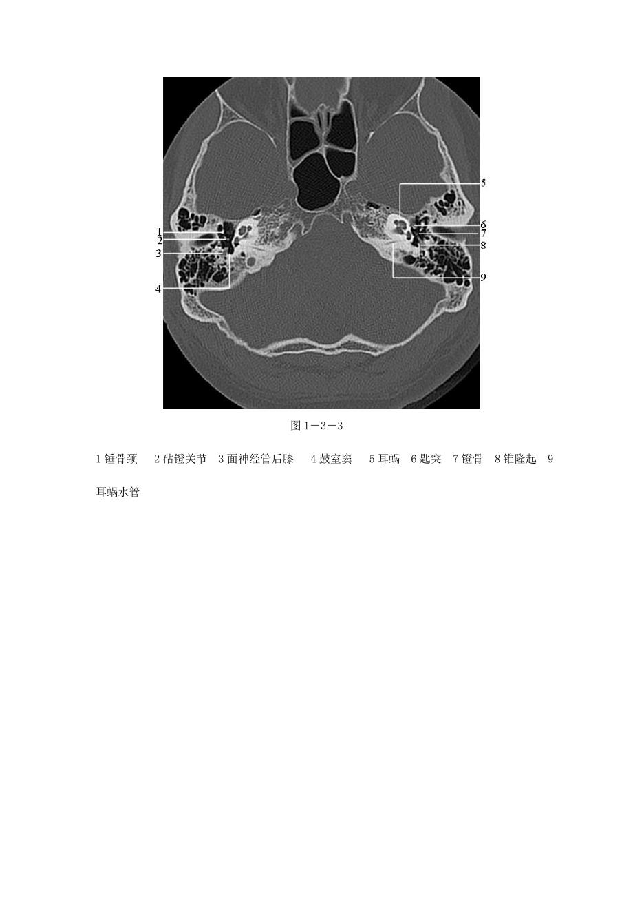 颞骨正常CT解剖(附图).doc_第3页