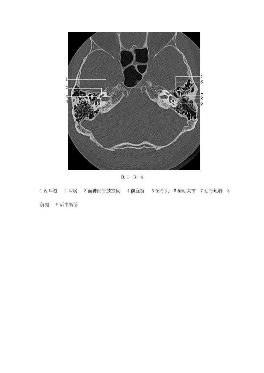 颞骨正常CT解剖(附图).doc_第4页