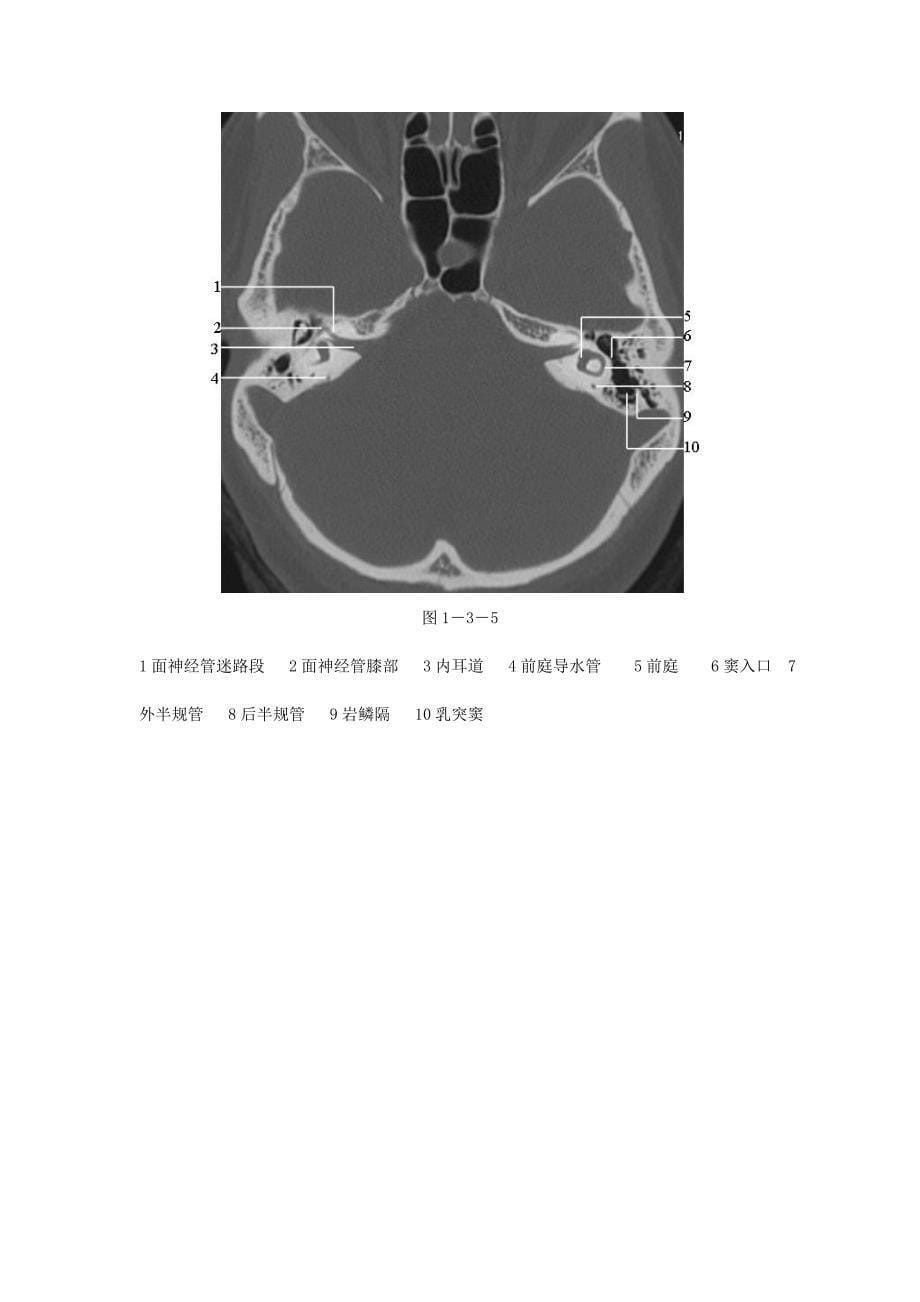 颞骨正常CT解剖(附图).doc_第5页