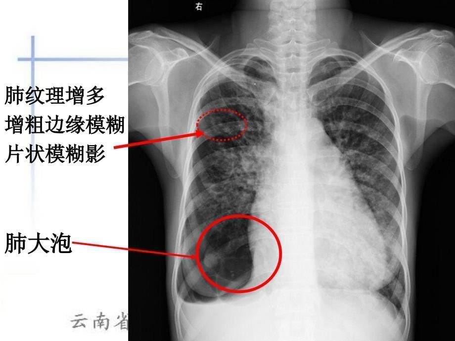 肺水肿的X线表现_第5页