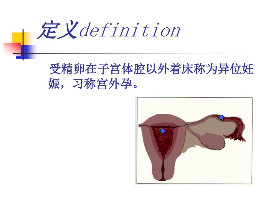 异位妊娠西医_第2页