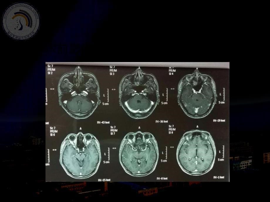 医学专题—桥小脑角胶质瘤_第5页