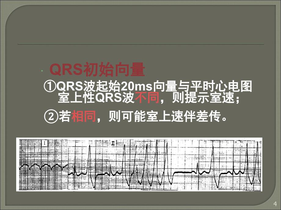 室速的诊断与鉴别诊断ppt课件_第4页