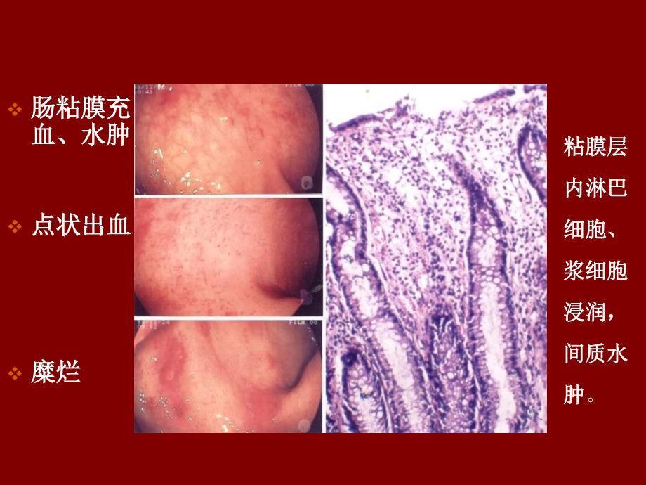 大肠疾病临床病理学2_第4页