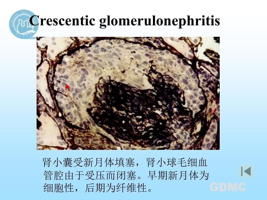 内科学教学课件：原发性肾小球疾病_第5页