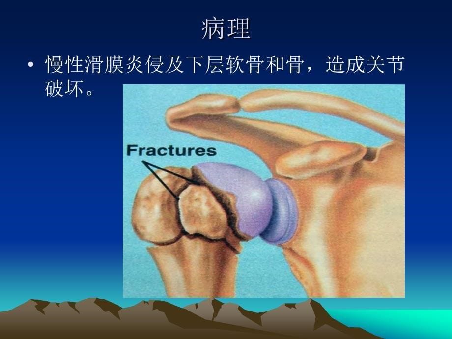 第讲类风湿性关节炎_第5页