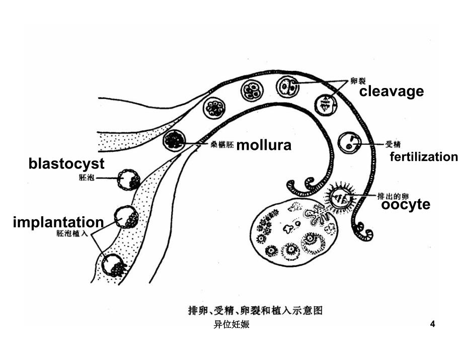 异位妊娠课件_第4页