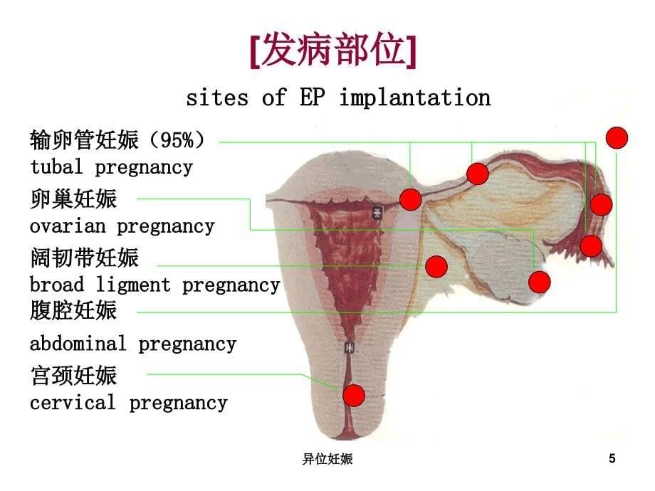 异位妊娠课件_第5页