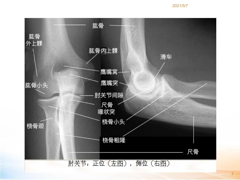 网球肘的症状_第3页