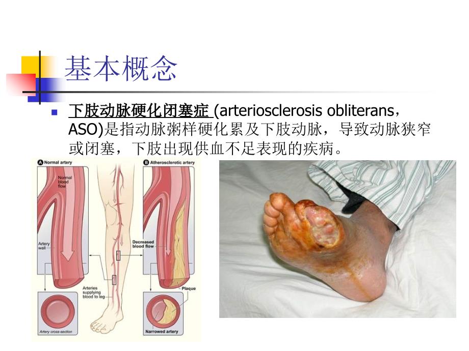 下肢动脉硬化闭塞的临床特点及治疗_第2页