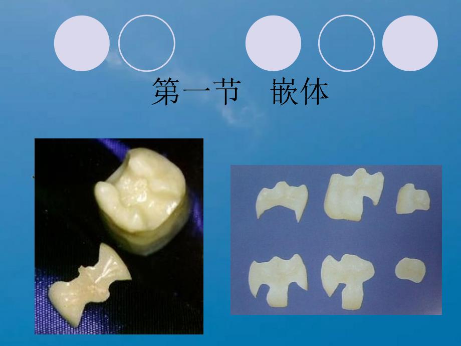 嵌体和部分冠ppt课件_第2页