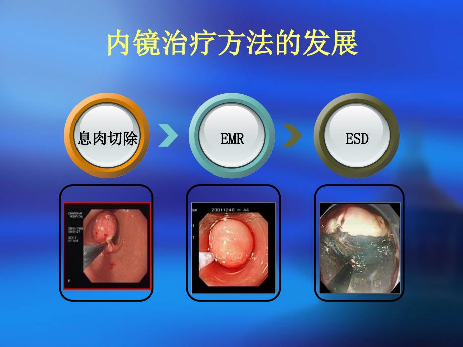 内镜下粘膜切除术_第2页