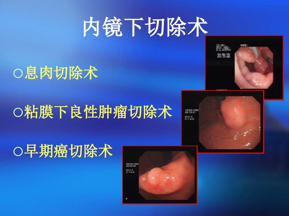 内镜下粘膜切除术_第3页