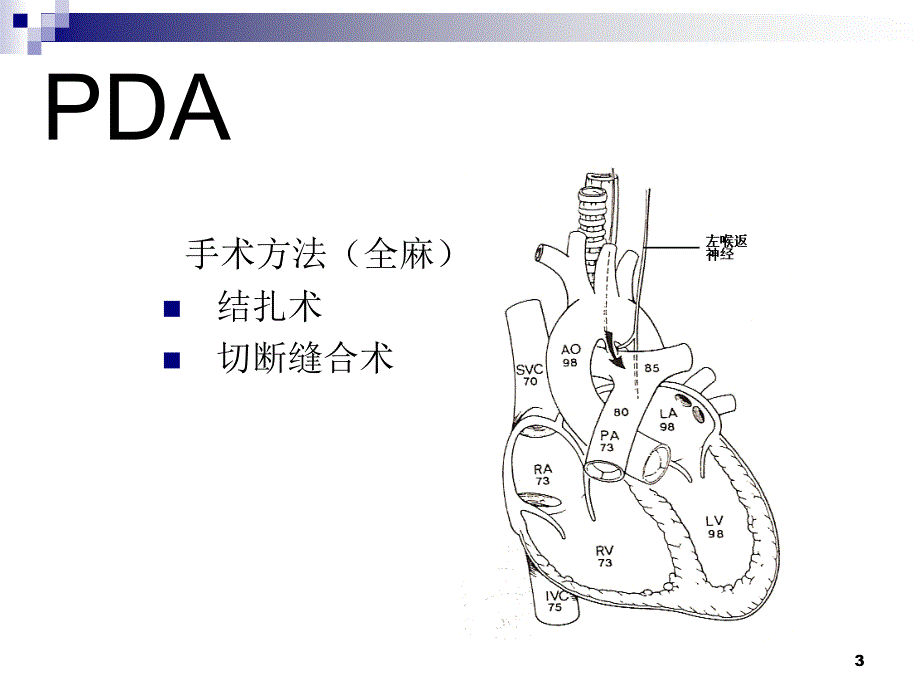 常见先天性心脏病术后护理PPT课件_第3页