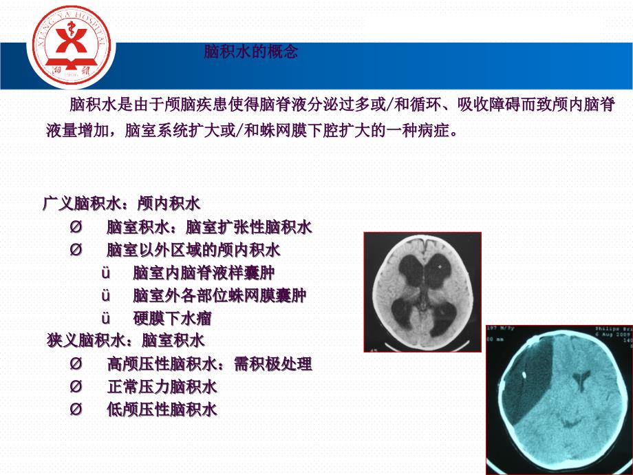 脑积水修改版ppt课件_第4页