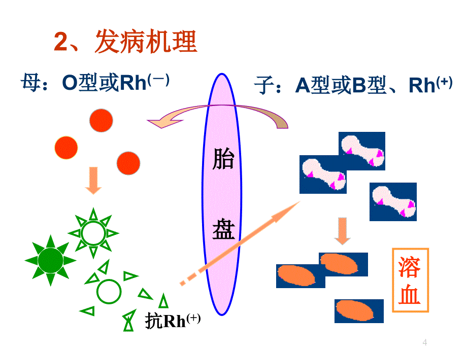 （精选课件）新生儿溶血_第4页