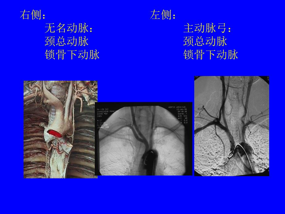 颈内动脉解剖_第3页