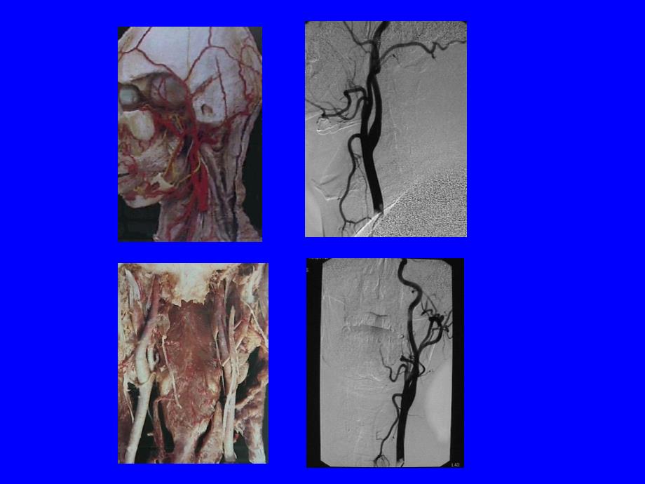颈内动脉解剖_第4页