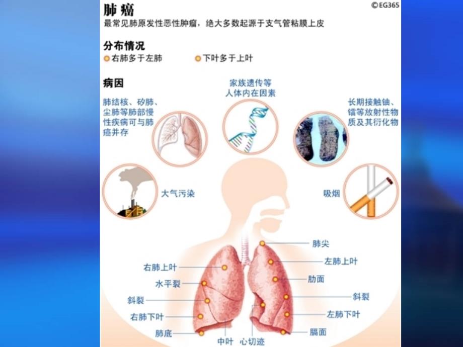 《支气管肺癌的护理》PPT课件_第4页