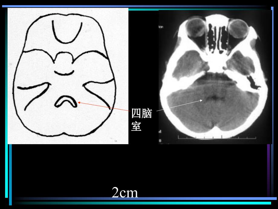 CT头颅解剖 PPT课件.ppt_第3页