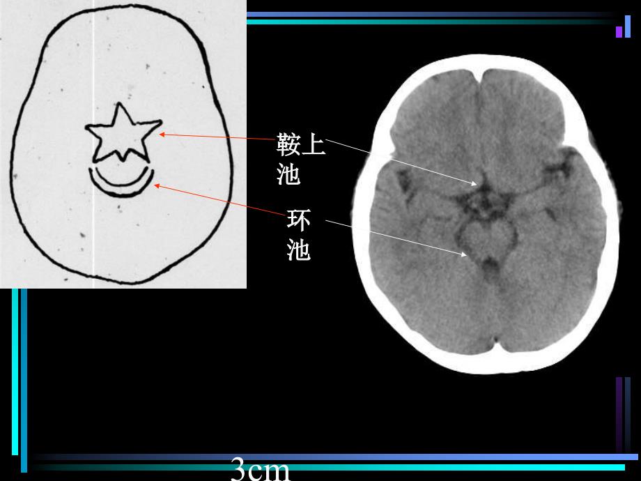 CT头颅解剖 PPT课件.ppt_第4页