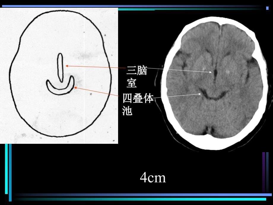 CT头颅解剖 PPT课件.ppt_第5页