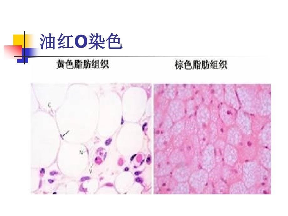 脂肪栓塞综合征zixin正1课件_第5页