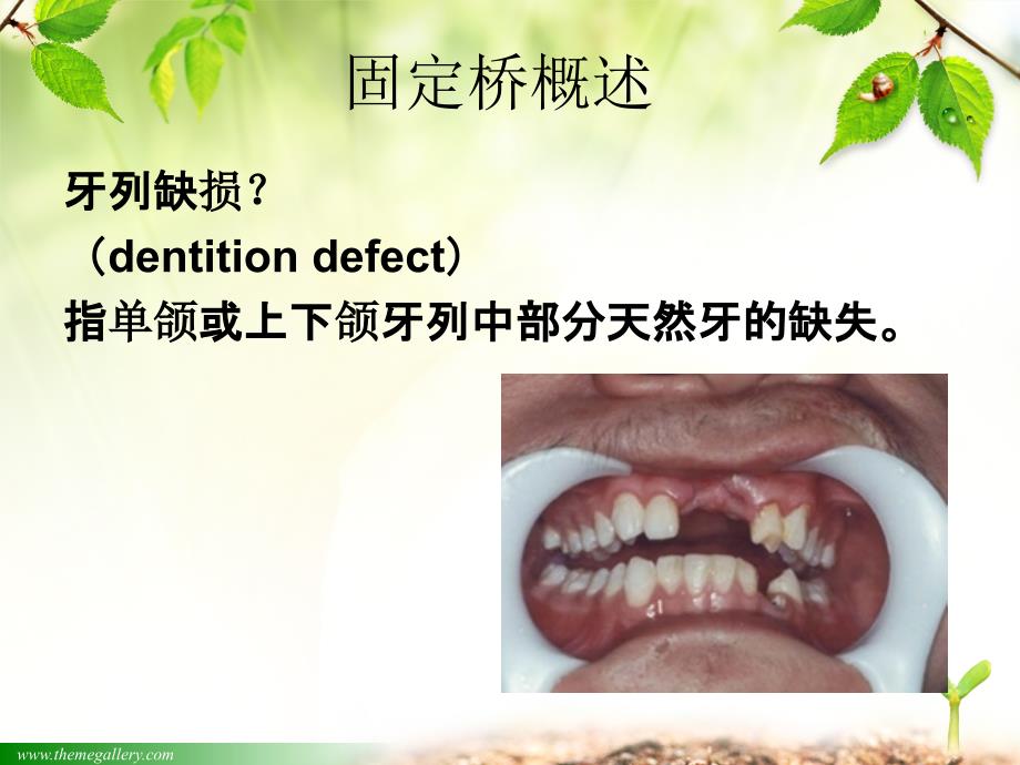 口腔修复学第五章固定桥_第3页