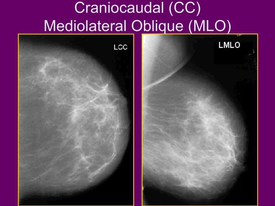 乳腺xr影本大课1ppt课件_第5页