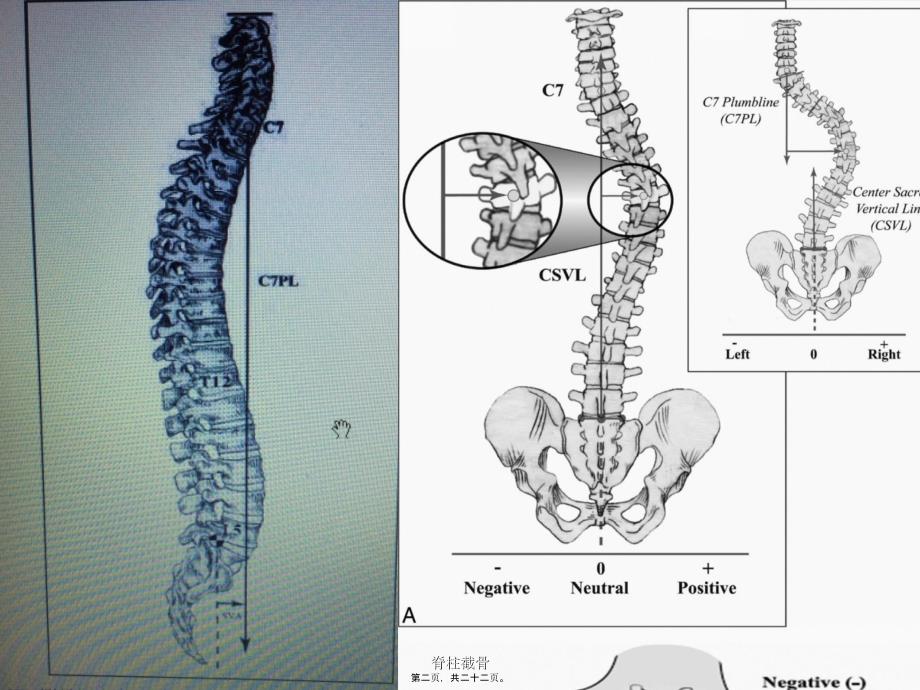 脊柱截骨课件_第2页