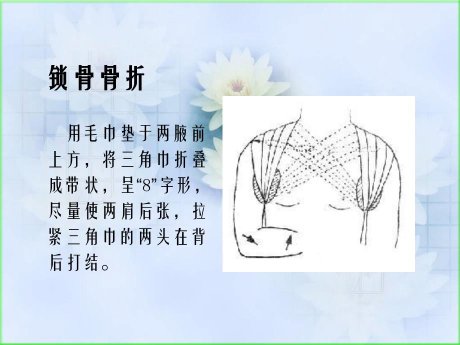 四肢骨折现场急救和固定_第4页