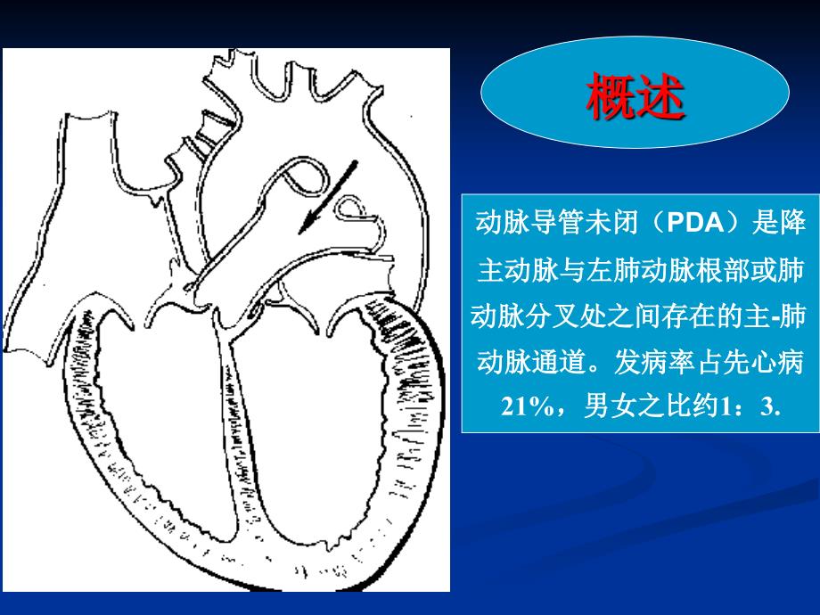 先心病法洛四联症TOF_第3页