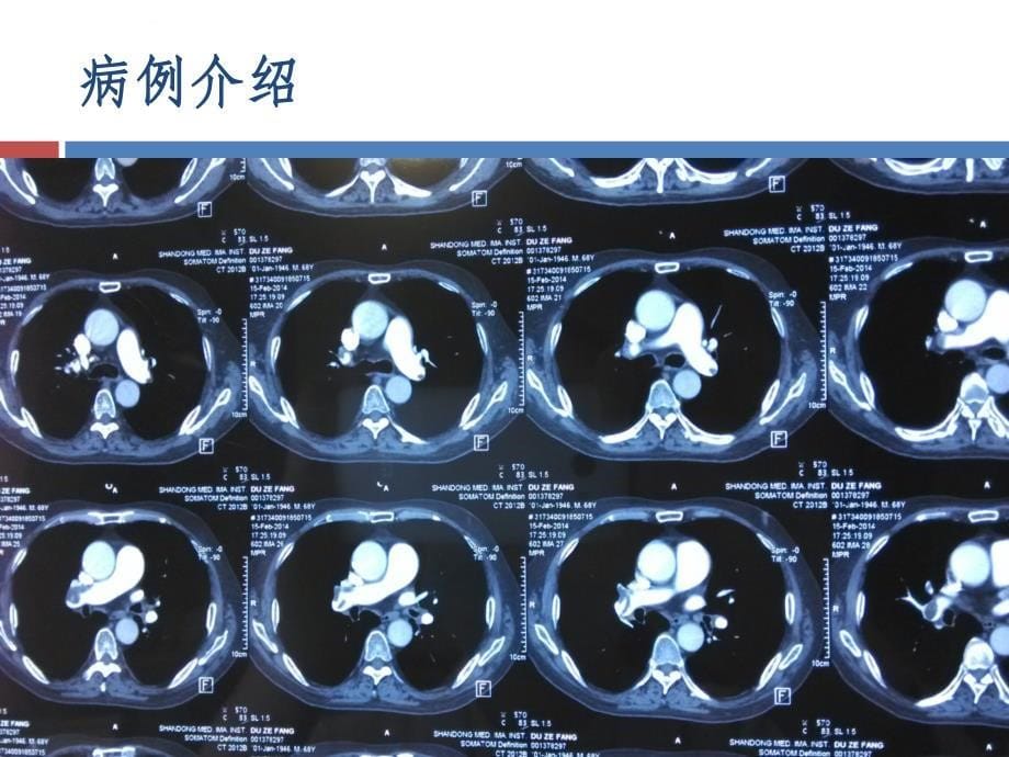 肺栓塞病例分析ppt课件_第5页