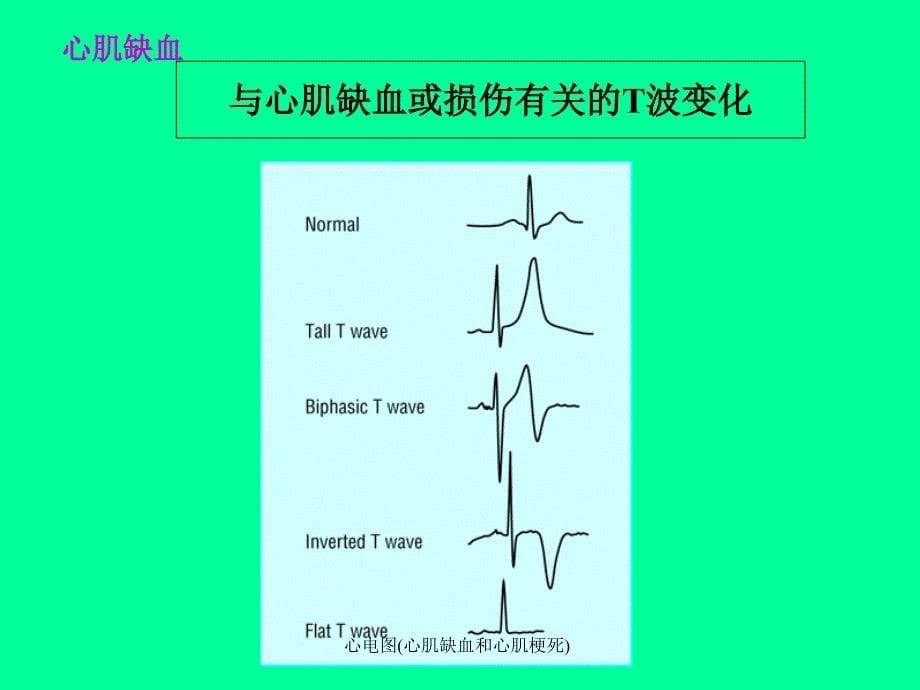 心电图(心肌缺血和心肌梗死)_第5页