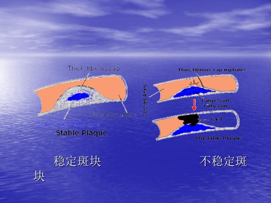 急性心肌梗死急诊教学_第3页