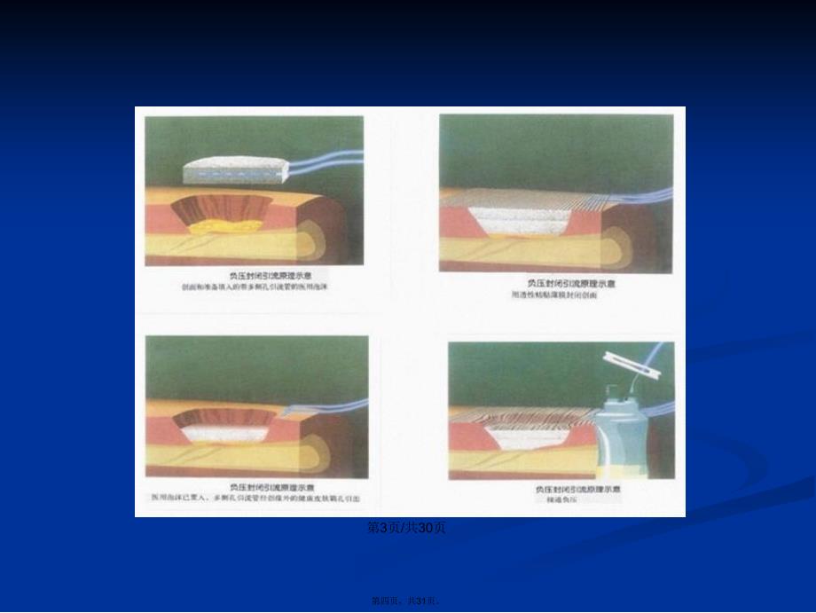 VSD负压吸引的应用及护理学习教案_第4页