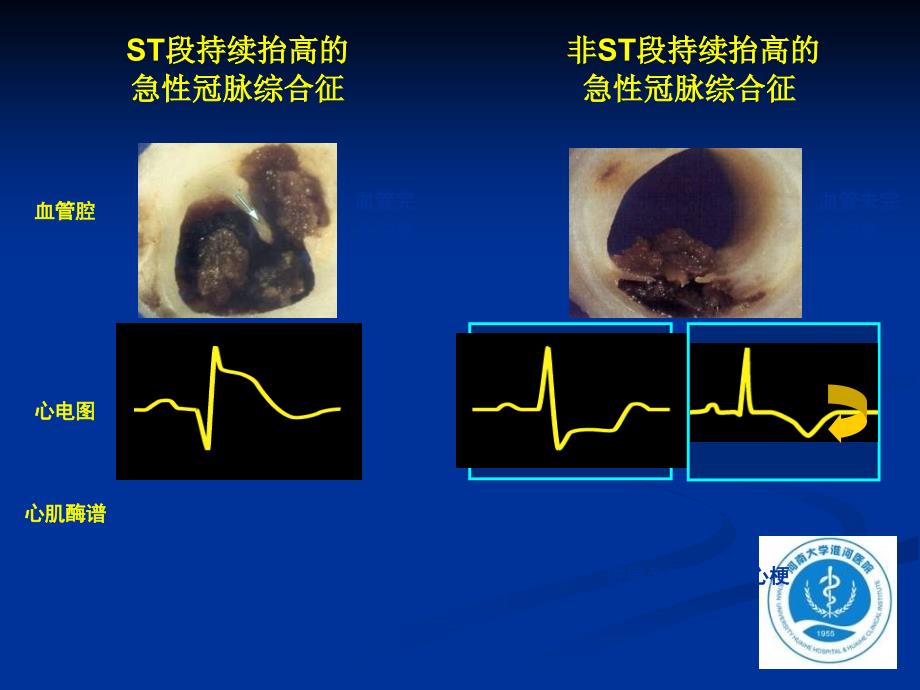 心肌梗死全球统一定义更新解读_第3页