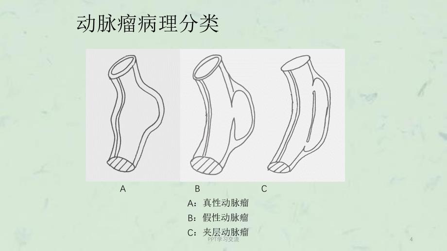 假性动脉瘤的治疗与护理最终版课件_第4页