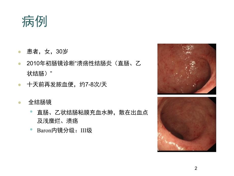 溃疡性结肠炎治疗规范ppt课件_第2页