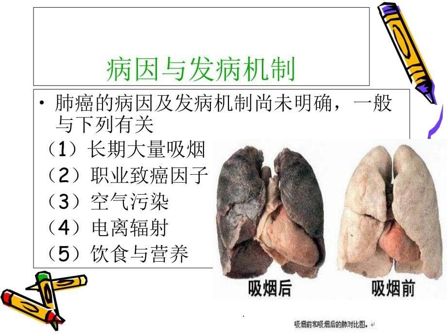 肺癌的护理查房2_第5页