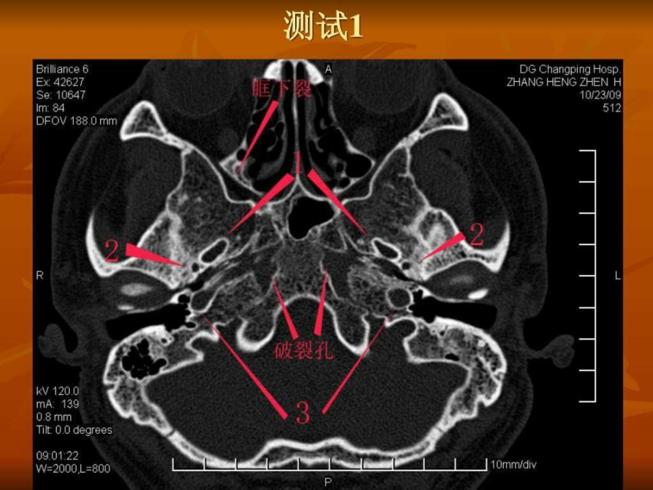 颅骨外伤性折CT诊断_第2页