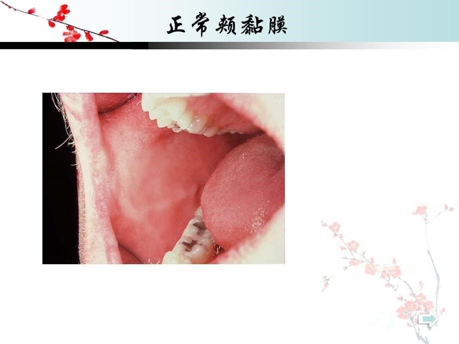 口腔科学：口 腔 黏 膜 病_第5页