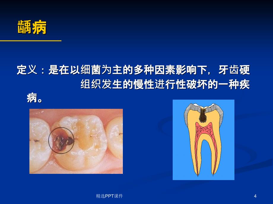 口腔常见病课件_第4页