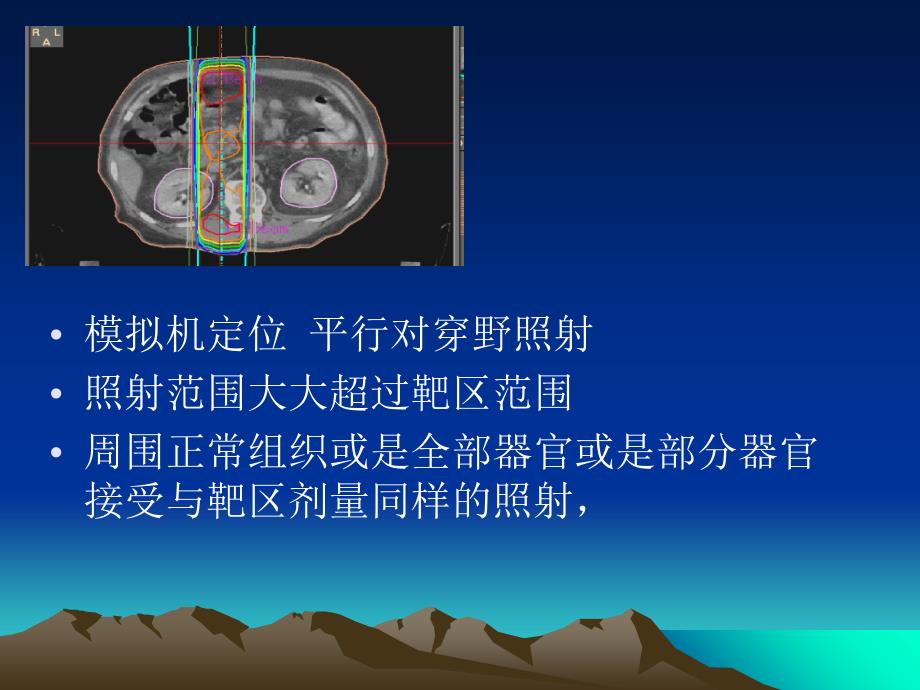 三维适形放疗中正常组织损伤及耐受剂量课件_第3页